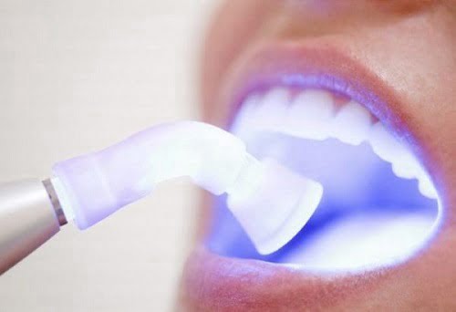 Tẩy trắng răng plasma có hại không? Lưu ý khi thực hiện 1