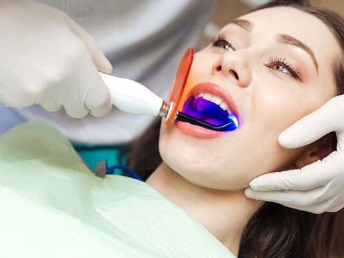 Tẩy trắng răng plasma có hại không? Lưu ý khi thực hiện 2
