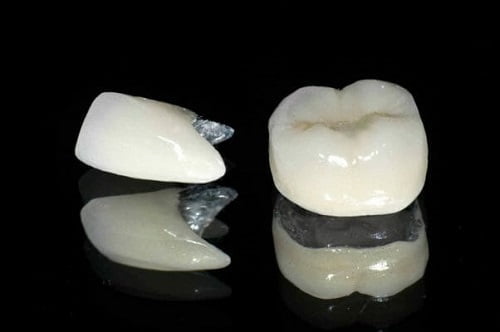 Có nên trồng răng sứ kim loại không? Tìm hiểu ngay 1
