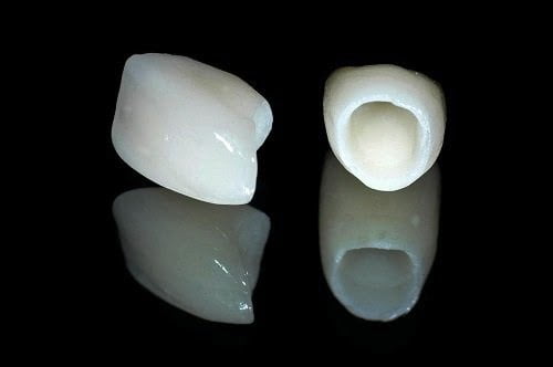 Trồng răng sứ không kim loại cần lưu ý gì? 1
