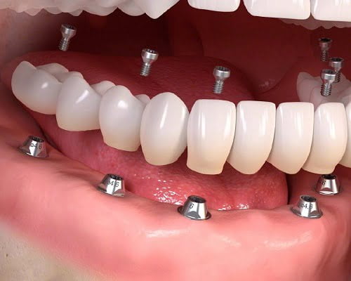 Kinh nghiệm làm răng implant từ khách hàng 1