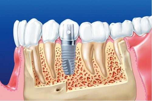 Kinh nghiệm làm răng implant từ khách hàng 3