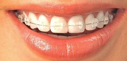Niềng răng xong có bị hô lại không? Nha khoa giải đáp cụ thể 2