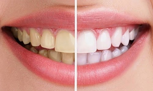 Niềng răng xong có nên tẩy trắng răng? Chuyên gia tư vấn 2
