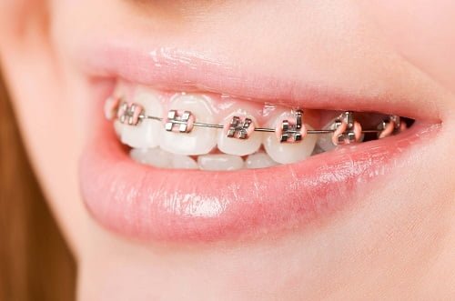 Niềng răng bị viêm lợi - Nguyên nhân và giải pháp 1