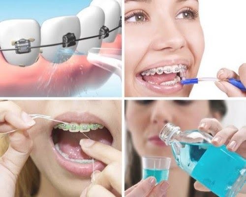 Niềng răng bị viêm lợi - Nguyên nhân và giải pháp 3