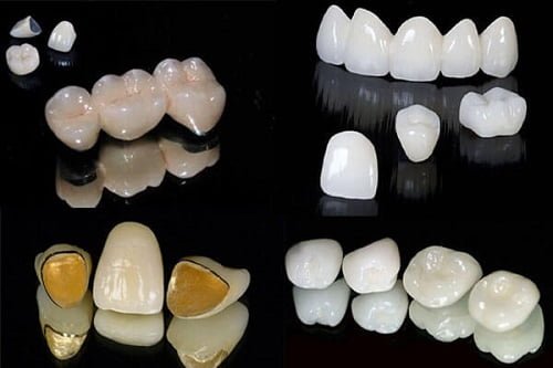 Trồng răng sứ có lâu không? Quy trình thực hiện ra sao? 3
