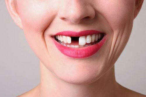 Trồng răng sứ có tốt không? Lợi ích khi trồng răng 1