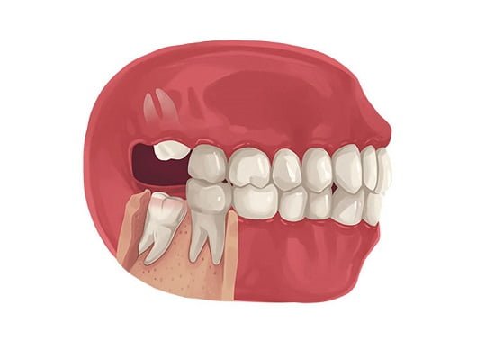 Nhổ 2 răng khôn hàm trên cần lưu ý gì? 1