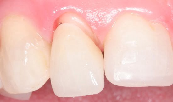 Răng sứ bị hở- 5 dấu hiệu nhận biết 1
